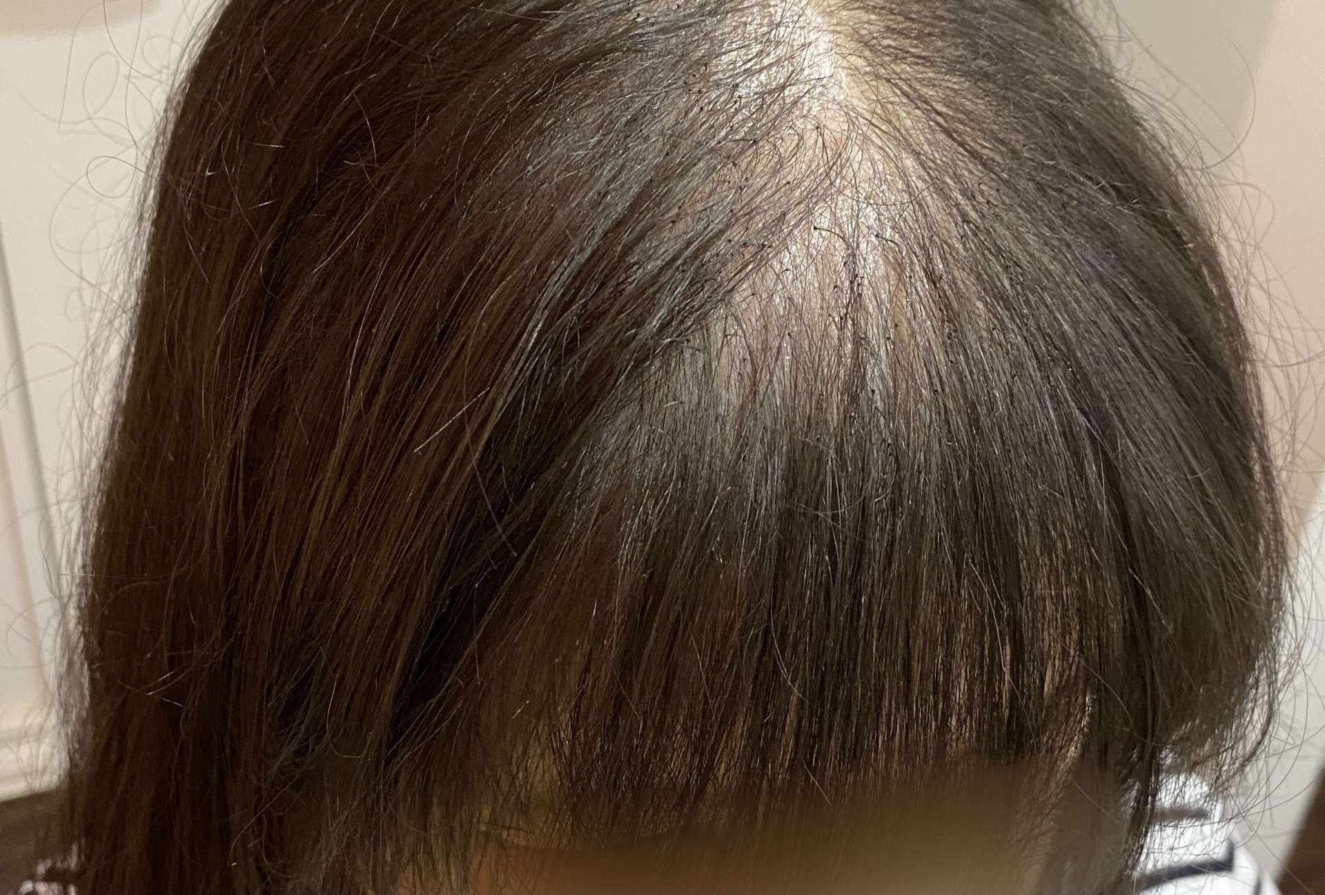 ふわりの増毛エクステ施術実例です。【福井で増毛、薄毛対策、薄毛改善なら「ふわり」】